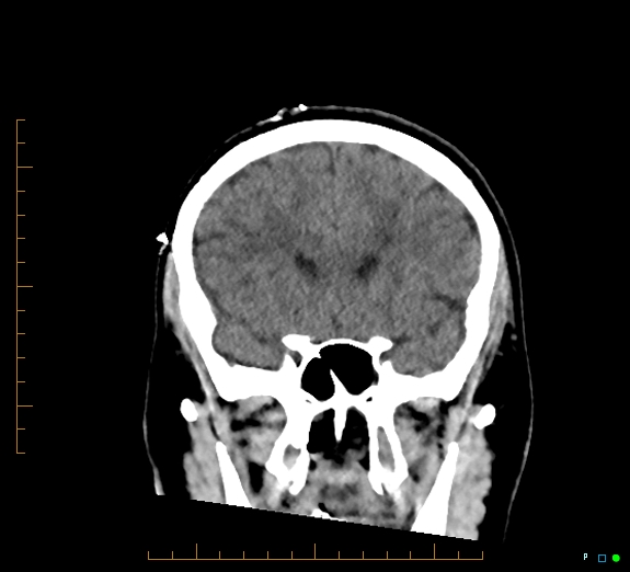 Cerebral fat embolism (Radiopaedia 85521-101220 Coronal non-contrast 23).jpg