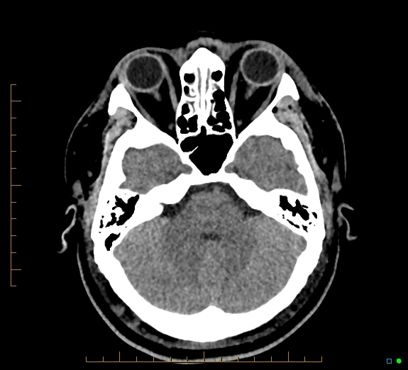 Cerebral fat embolism (Radiopaedia 85521-101224 Axial non-contrast 14).jpg