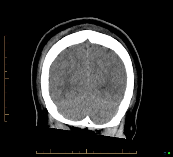 Cerebral fat embolism (Radiopaedia 85521-101224 Coronal non-contrast 52).jpg