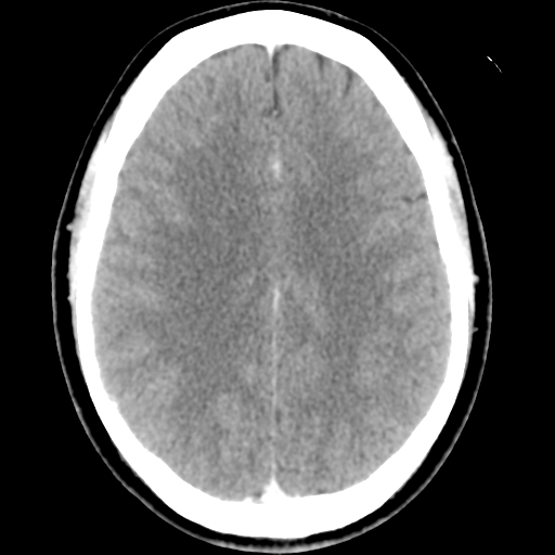 File:Cerebral hemorrhage secondary to arteriovenous malformation (Radiopaedia 33497-34561 B 36).png