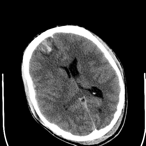 File:Cerebral hemorrhagic contusions- temporal evolution (Radiopaedia 40224-42752 Axial non-contrast 15).png