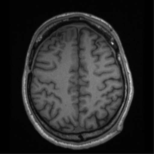 File:Cerebral hemorrhagic contusions- temporal evolution (Radiopaedia 40224-42757 Axial T1 58).png
