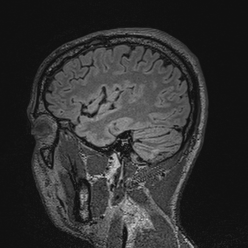 File:Cerebral hemorrhagic contusions- temporal evolution (Radiopaedia 40224-42757 Sagittal T1 21).png