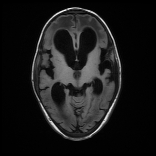 File:Cerebral manifestations of mucopolysaccharidosis type I (Radiopaedia 59171-66487 C 9).jpg