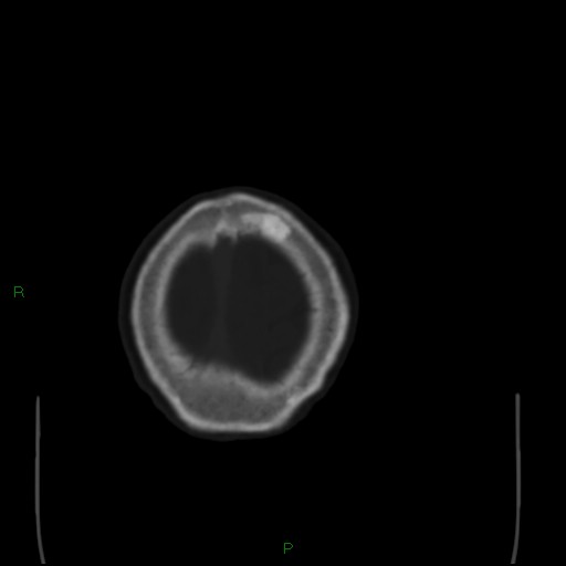 File:Cerebral metastases - breast primary (Radiopaedia 77653-89857 Axial bone window 109).jpg