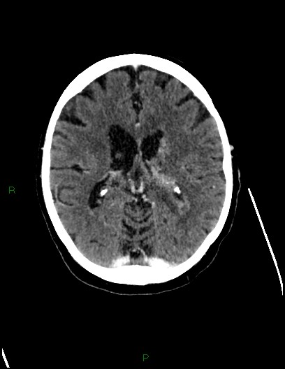 Cerebral metastases - ependymal and parenchymal (Radiopaedia 79877-93131 Axial C+ delayed 46).jpg