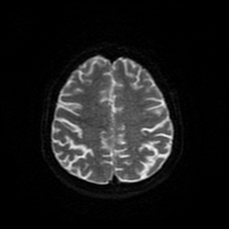 Cerebral metastases - melanoma (Radiopaedia 80972-94522 Axial DWI 86).jpg