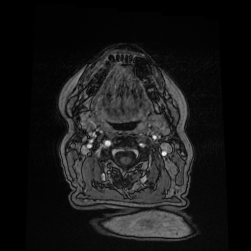 Cerebral metastases - melanoma (Radiopaedia 80972-94522 Axial T1 C+ 4).jpg