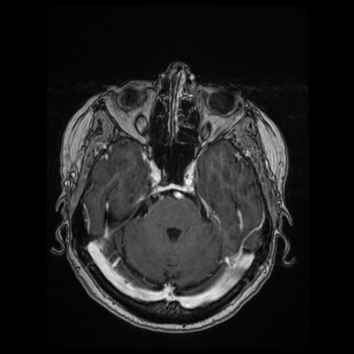 File:Cerebral metastases - melanoma (Radiopaedia 80972-94522 Axial T1 C+ 40).jpg