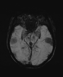 File:Cerebral metastasis (Radiopaedia 46744-51248 Axial SWI 13).png
