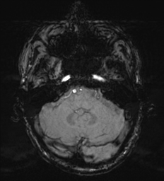 Cerebral metastasis - melanoma (Radiopaedia 54718-60954 Axial SWI 13).png