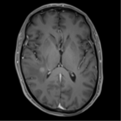 Cerebral metastasis - melanoma (Radiopaedia 54718-60954 Axial T1 C+ fat sat 28).png