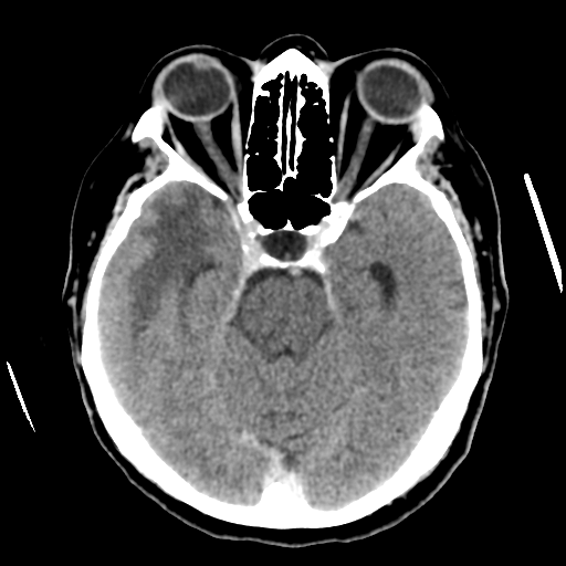 Cerebral metastasis to basal ganglia (Radiopaedia 81568-95412 Axial C+ delayed 22).png