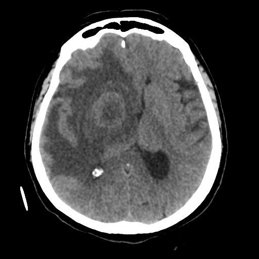 Cerebral metastasis to basal ganglia (Radiopaedia 81568-95412 Axial non-contrast 34).png