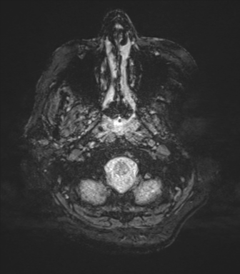 File:Cerebral metastasis to basal ganglia (Radiopaedia 81568-95413 Axial SWI magnitude 4).png