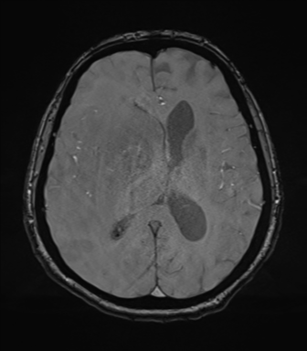 Cerebral metastasis to basal ganglia (Radiopaedia 81568-95413 Axial SWI magnitude 49).png