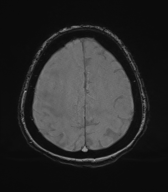 Cerebral metastasis to basal ganglia (Radiopaedia 81568-95413 Axial SWI magnitude 69).png