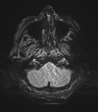 Cerebral metastasis to basal ganglia (Radiopaedia 81568-95413 Axial SWI magnitude 8).png