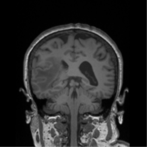 Cerebral metastasis to basal ganglia (Radiopaedia 81568-95413 Coronal T1 15).png