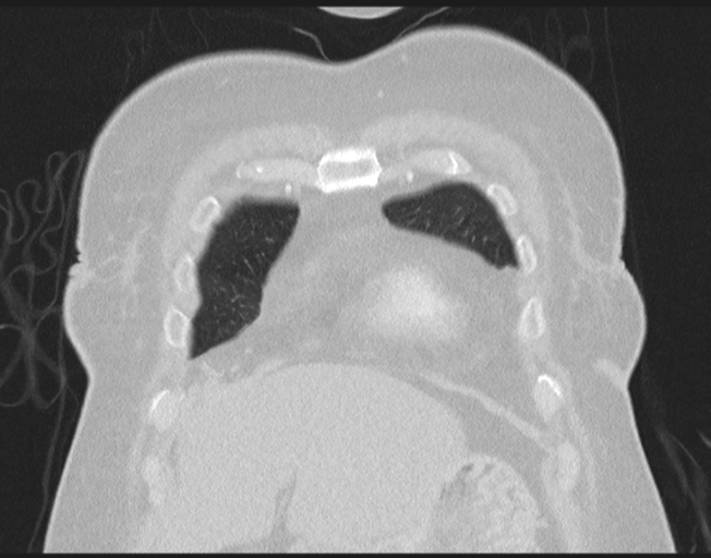 Cerebral metastasis to basal ganglia (Radiopaedia 81568-95414 Coronal lung window 18).png