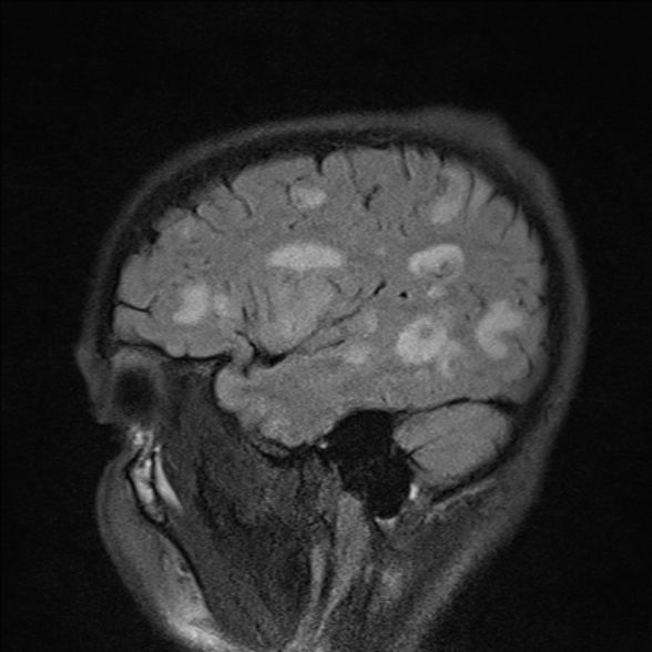 File:Cerebral toxoplasmosis (Radiopaedia 53993-60132 Sagittal FLAIR 22).jpg