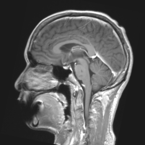File:Cerebral toxoplasmosis (Radiopaedia 53993-61435 Coronal T1 18).jpg