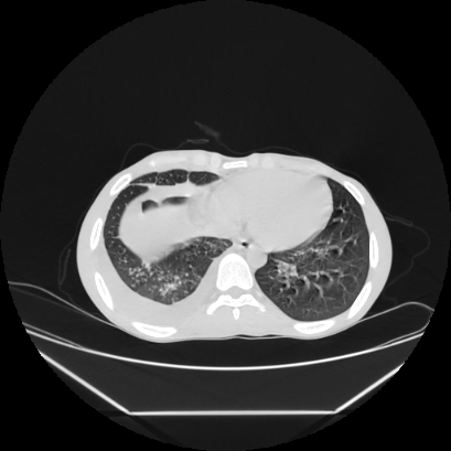 Cerebral tuberculoma (Radiopaedia 80829-94318 Axial lung window 138).jpg