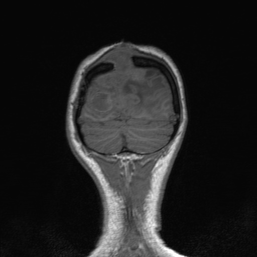 Cerebral tuberculosis with dural sinus invasion (Radiopaedia 60353-68090 Coronal T1 160).jpg