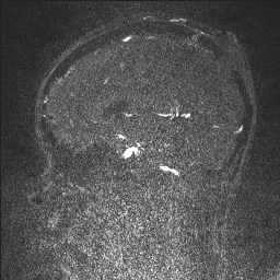 Cerebral tuberculosis with dural sinus invasion (Radiopaedia 60353-68090 Sagittal MRV 81).jpg