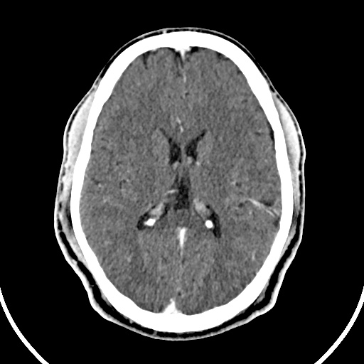 Cerebral venous angioma (Radiopaedia 69959-79977 B 55).jpg