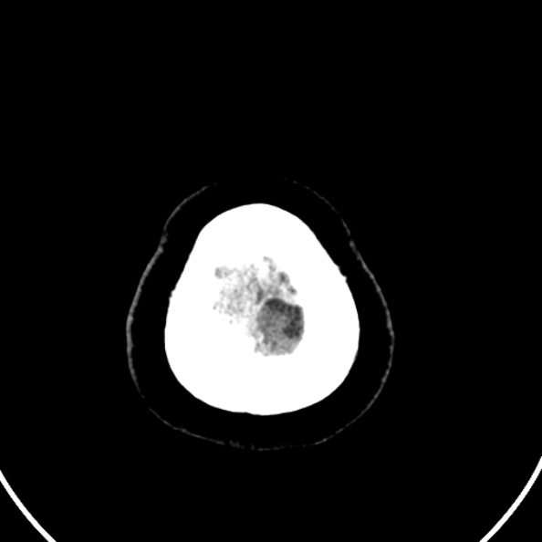 File:Cerebral venous hemorrhagic infarct from venous sinus thrombosis (Radiopaedia 55433-61883 Axial C+ delayed 10).jpg