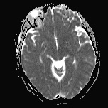 File:Cerebral venous infarction - hemorrhagic (Radiopaedia 81625-95505 Axial ADC 10).jpg