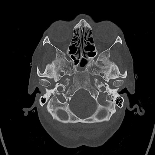 Cerebral venous infarction with hemorrhage (Radiopaedia 65343-74381 Axial bone window 12).jpg