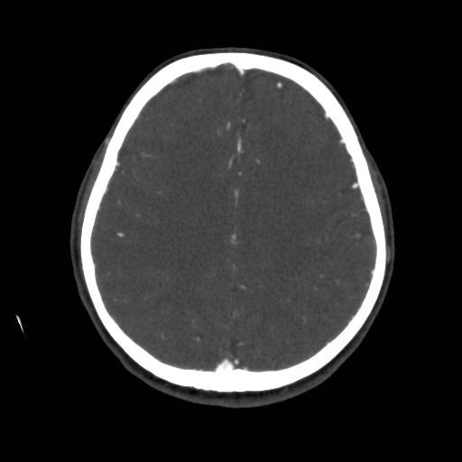 Cerebral venous sinus thrombosis (Radiopaedia 40619-43227 A 157).jpg