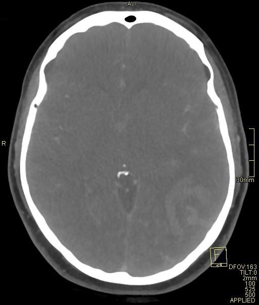 Cerebral venous sinus thrombosis (Radiopaedia 91329-108965 Axial venogram 41).jpg