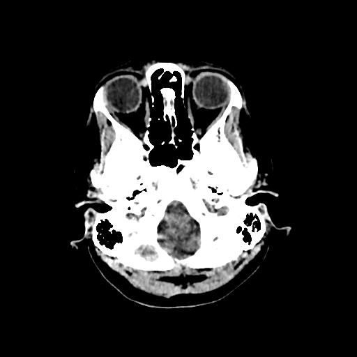 Cerebral venous throbmosis - hemorrhagic venous infarction (Radiopaedia 87318-103613 Axial non-contrast 24).jpg