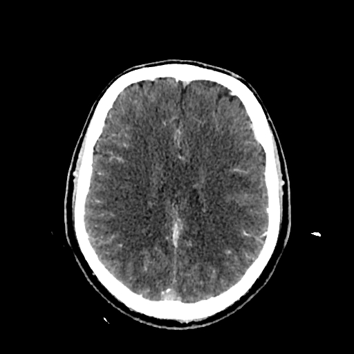 File:Cerebral venous thrombosis (CVT) (Radiopaedia 77524-89685 Axial with contrast 24).jpg