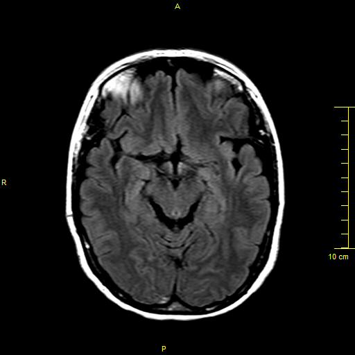 File:Cerebral venous thrombosis (Radiopaedia 23288-23351 Axial FLAIR 7).JPG