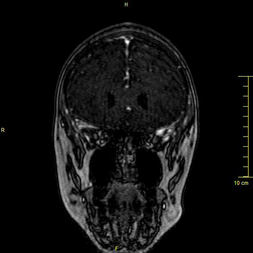 File:Cerebral venous thrombosis (Radiopaedia 23288-23351 MRV 23).JPG