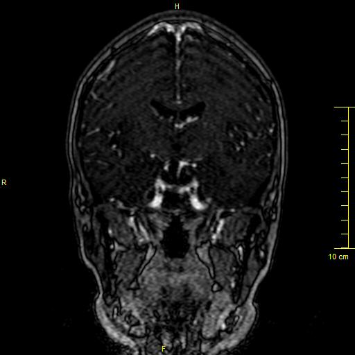Cerebral venous thrombosis (Radiopaedia 23288-23351 MRV 68).JPG