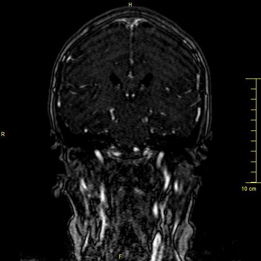 Cerebral venous thrombosis (Radiopaedia 23288-23351 MRV 88).JPG