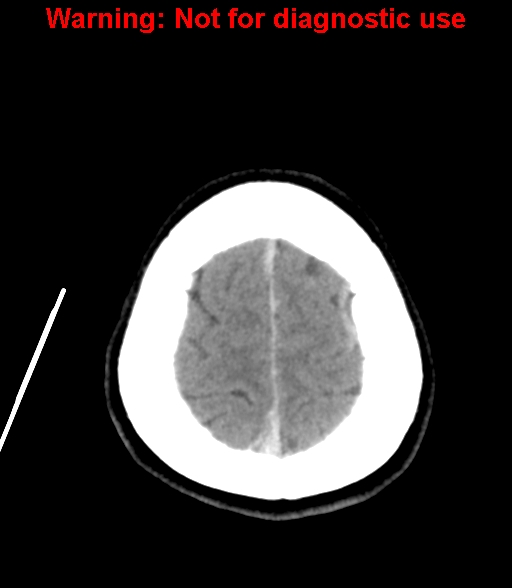 File:Cerebral venous thrombosis (Radiopaedia 37224-38992 Axial non-contrast 26).jpg