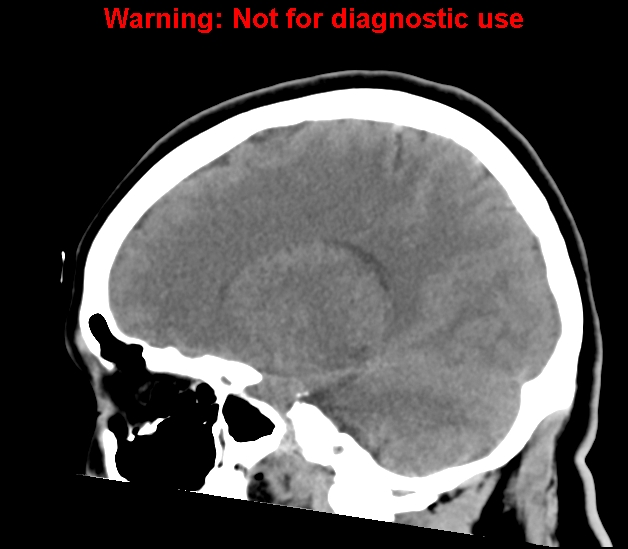 File:Cerebral venous thrombosis (Radiopaedia 37224-38992 B 19).jpg