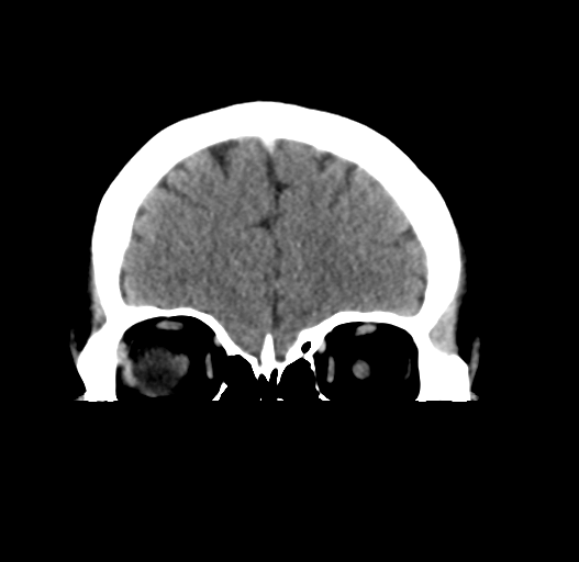 File:Cerebral venous thrombosis (Radiopaedia 38392-40467 Coronal non-contrast 8).png