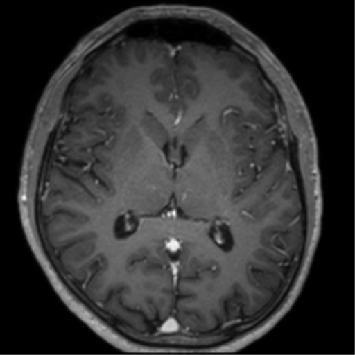 Cerebral venous thrombosis (Radiopaedia 38392-40469 Axial T1 C+ 43).png