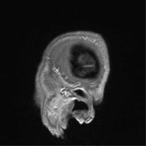 Cerebral venous thrombosis (Radiopaedia 38392-40469 Sagittal T1 C+ 82).png