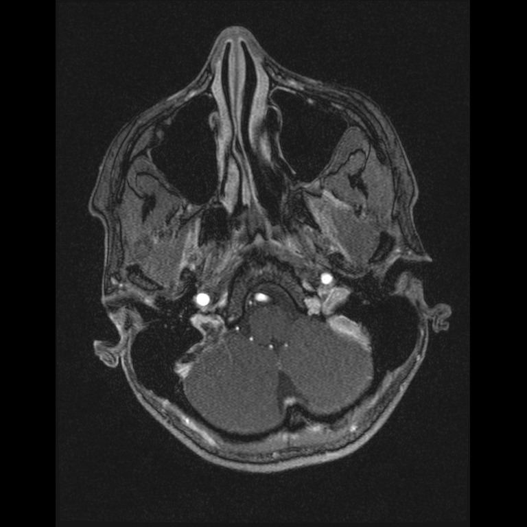 Cerebral venous thrombosis (Radiopaedia 45678-49854 Axial MRV 6).jpg