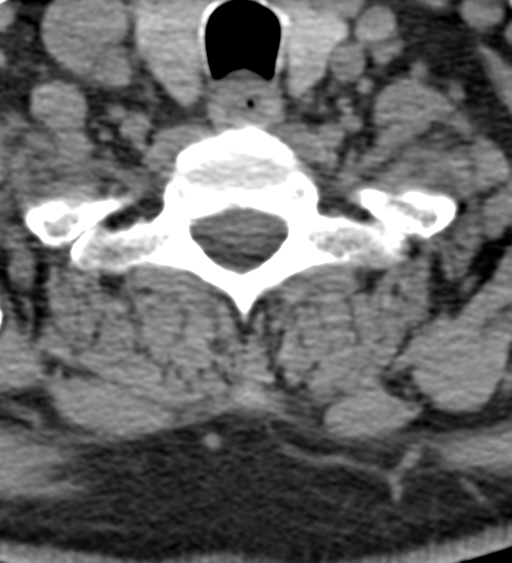 File:Cervical canal stenosis - OPLL and osteophytes (Radiopaedia 47329-51910 Axial non-contrast 51).png