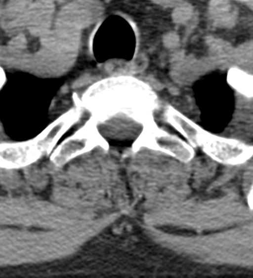 Cervical canal stenosis due to ossification of the posterior longitudinal ligament (Radiopaedia 47260-51823 Axial non-contrast 57).png