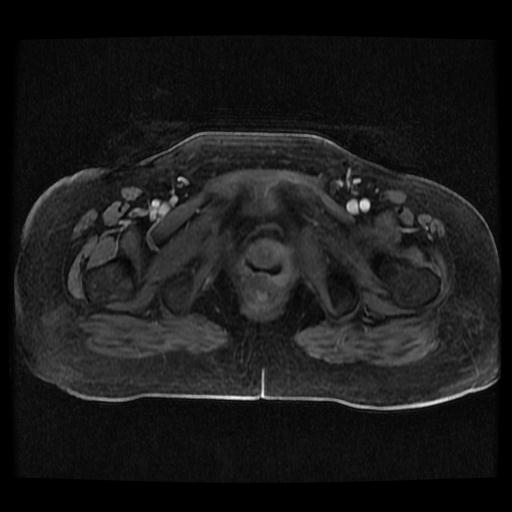 Cervical carcinoma (Radiopaedia 70924-81132 Axial T1 C+ fat sat 205).jpg
